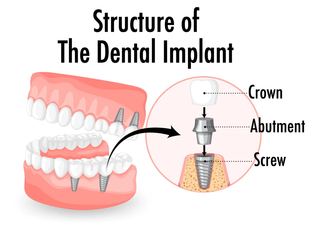 dental implants